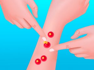 Pimple Poper Rush Online Arcade Game